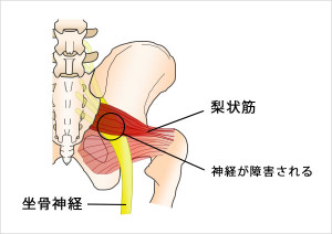 梨状筋
